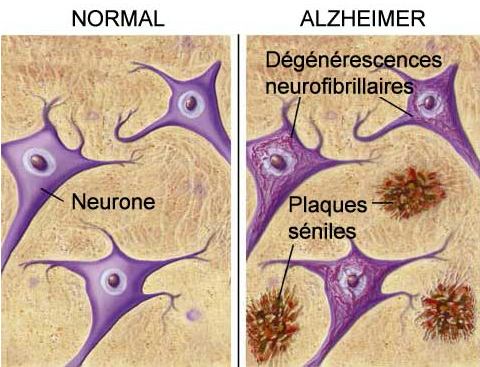 Alzheimer, maladie infectieuse